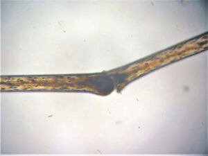 Color Dilute Alopecia CDA