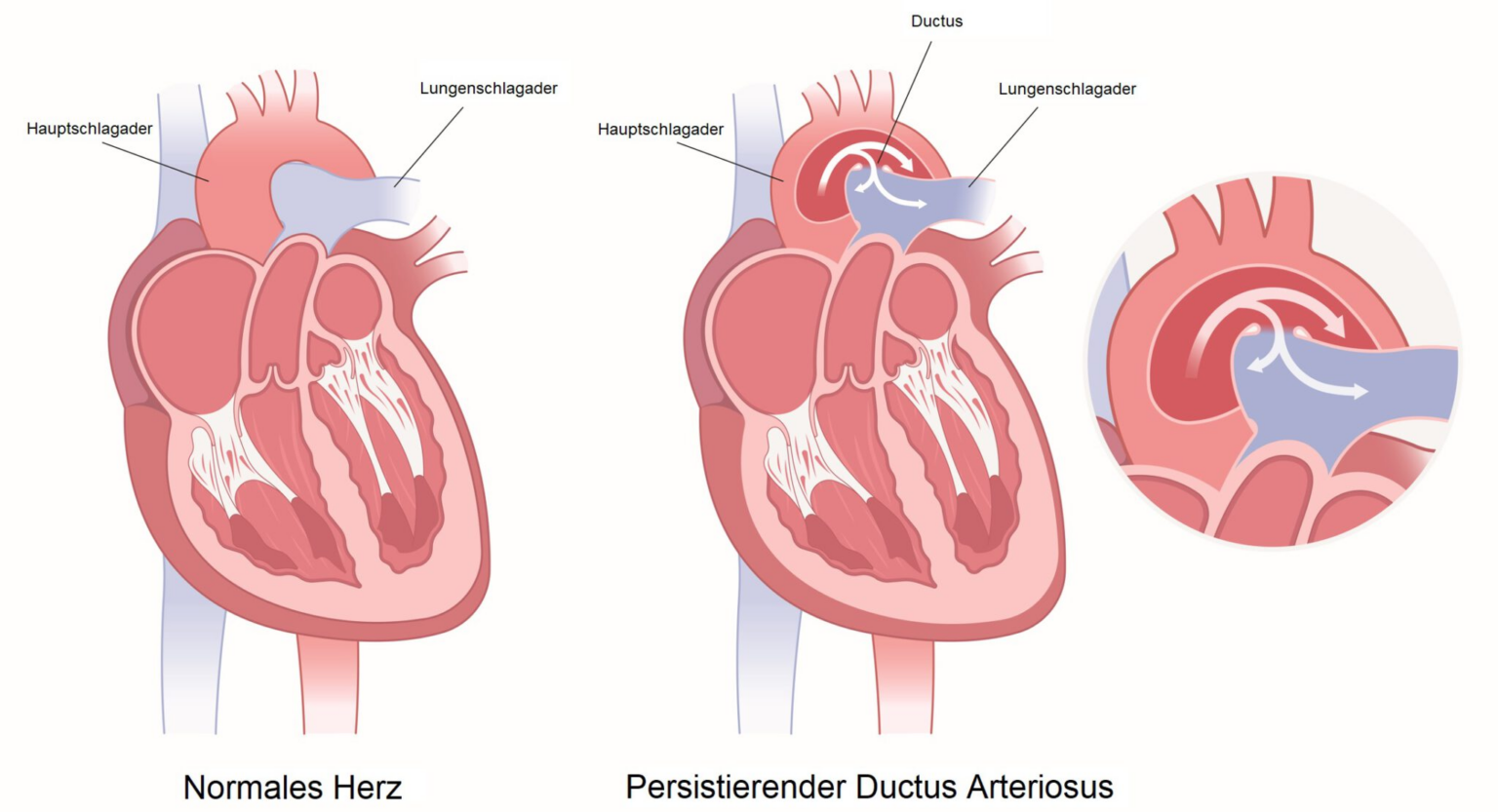 Ductus Arteriosus Botalli (PDA)
