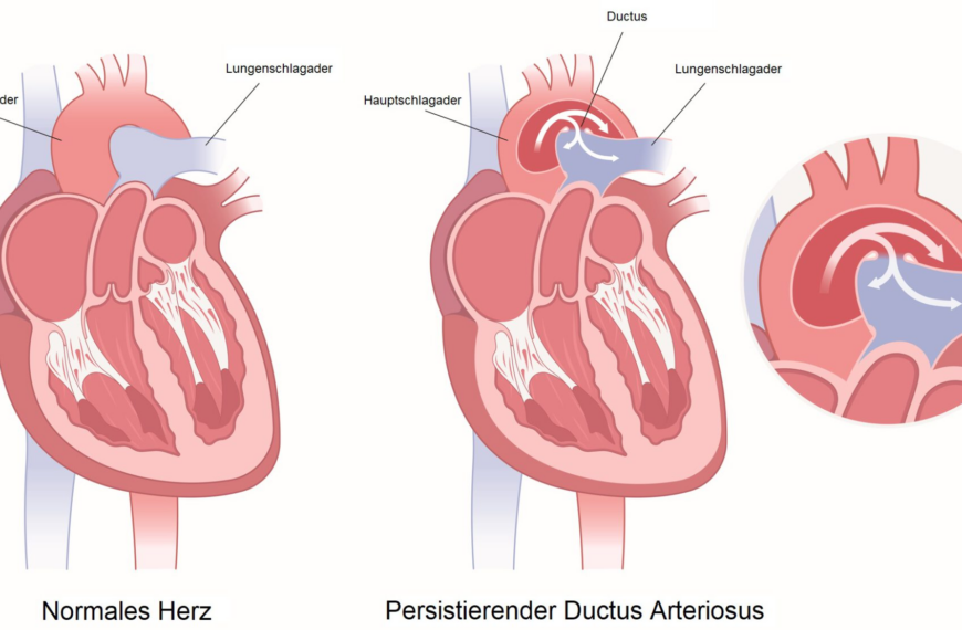Ductus Arteriosus Botalli (PDA)